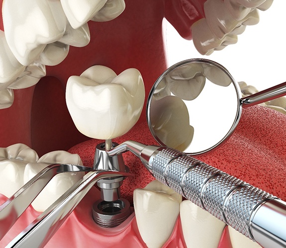 Dental implant and abutment