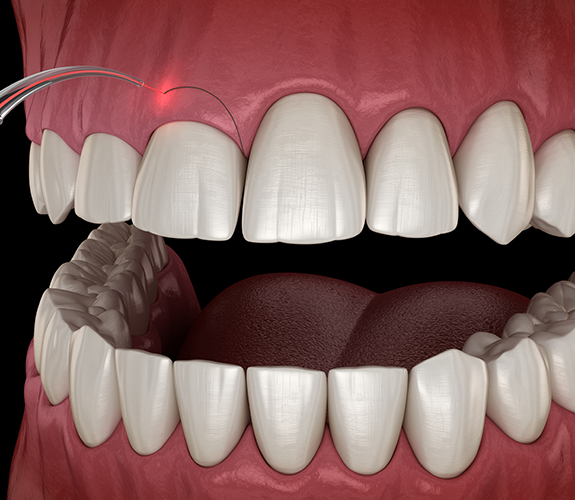 Animated smile during gum recontouring treatment