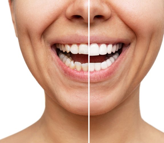 Before and after veneers in Wilmington 