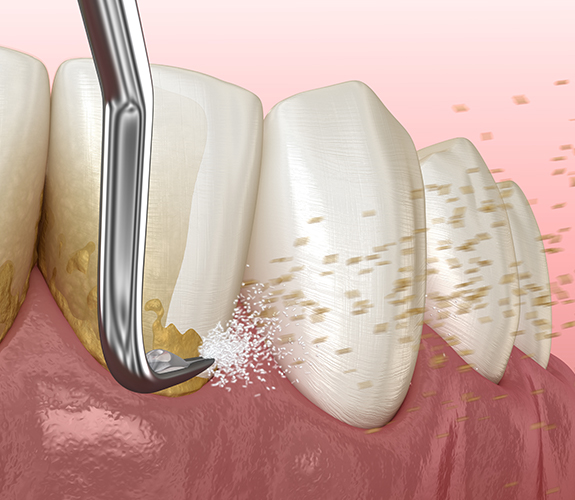 Animated smile during scaling and root planing periodontal therapy