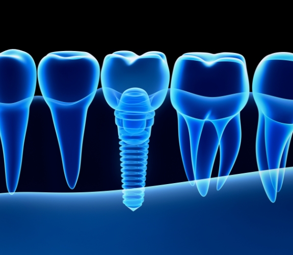 Dentist pointing to dental implant supported dental crown model