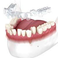 Invisalign aligner in Wilmington