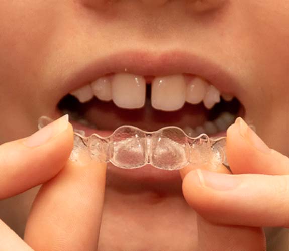 Closeup of teen using Invisalign Teen in Wilmington