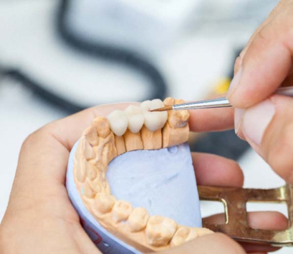 Dental bridge in Wilmington being created