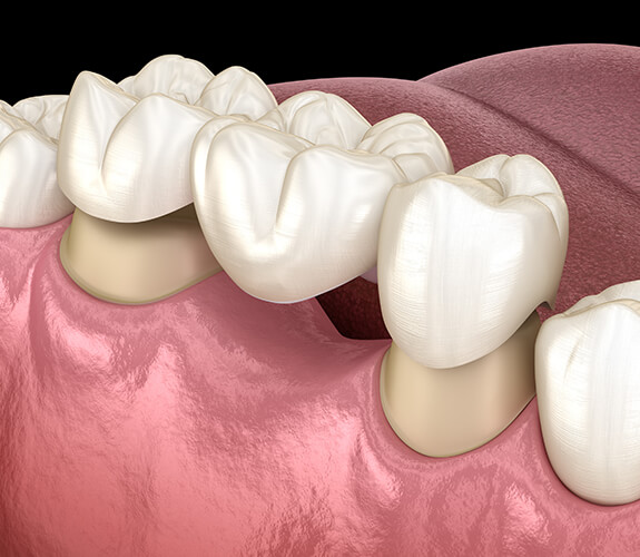 Animated dental bridge placement