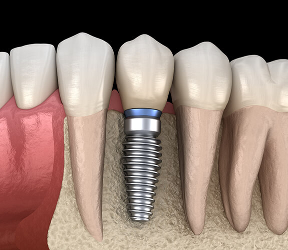 Animated dental implant supported dental crown