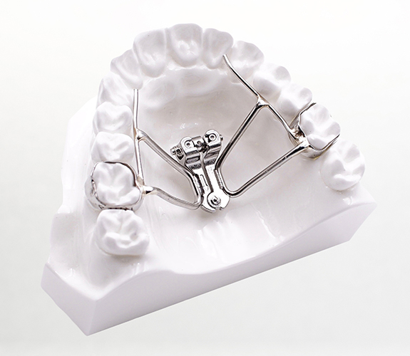 Orthodontic appliance on smile model