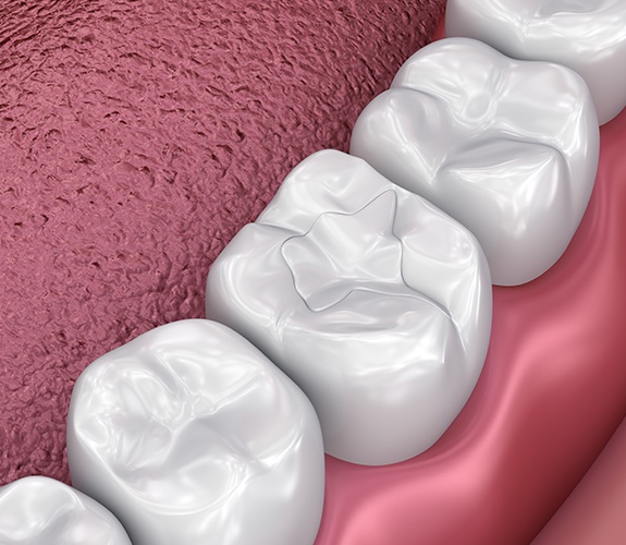 Animated smile with tooth colored filling restorative dentistry treatment