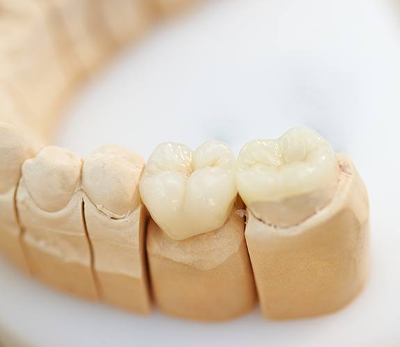 Model teeth with porcelain inlay and onlay samples