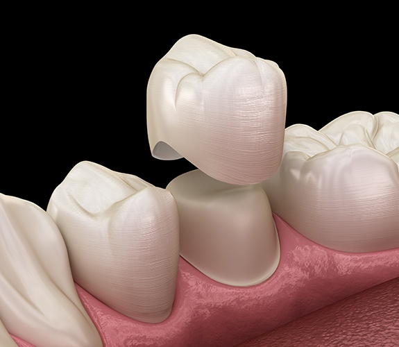 Animated dental crown placement