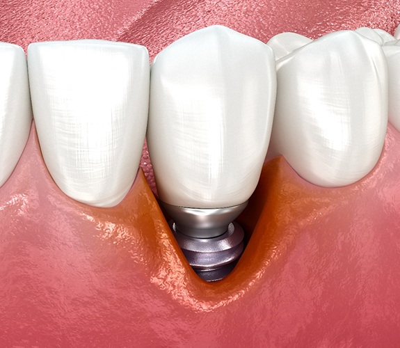 Failed dental implant