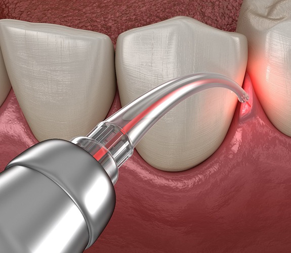 Illustration of laser treatment of gum disease in Wilmington, IL