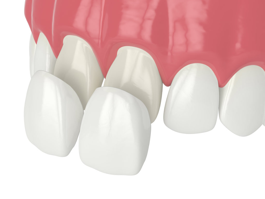 Render of veneers being placed on teeth