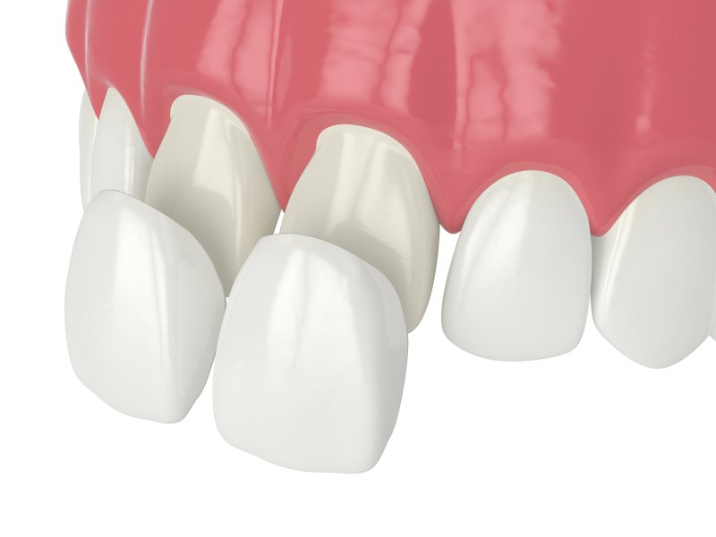 dental image of veneers  